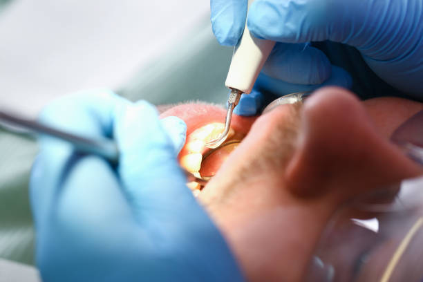 Best Emergency Dental Care for Broken or Chipped Teeth in Onset, MA