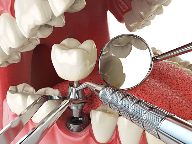 Best Emergency Dental Care for Broken or Chipped Teeth in Onset, MA